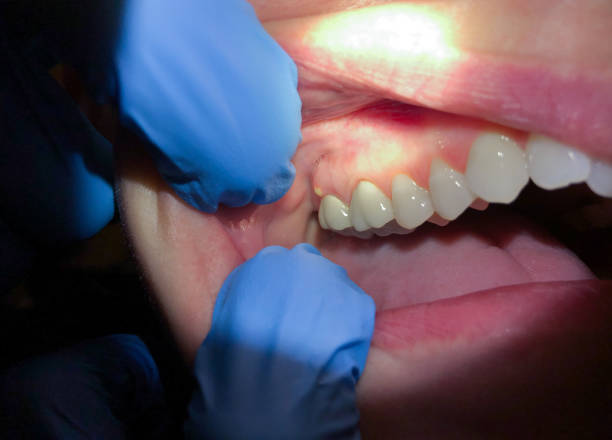 Best Emergency Dentist for Lost Fillings or Crowns in Griggsvle, IL